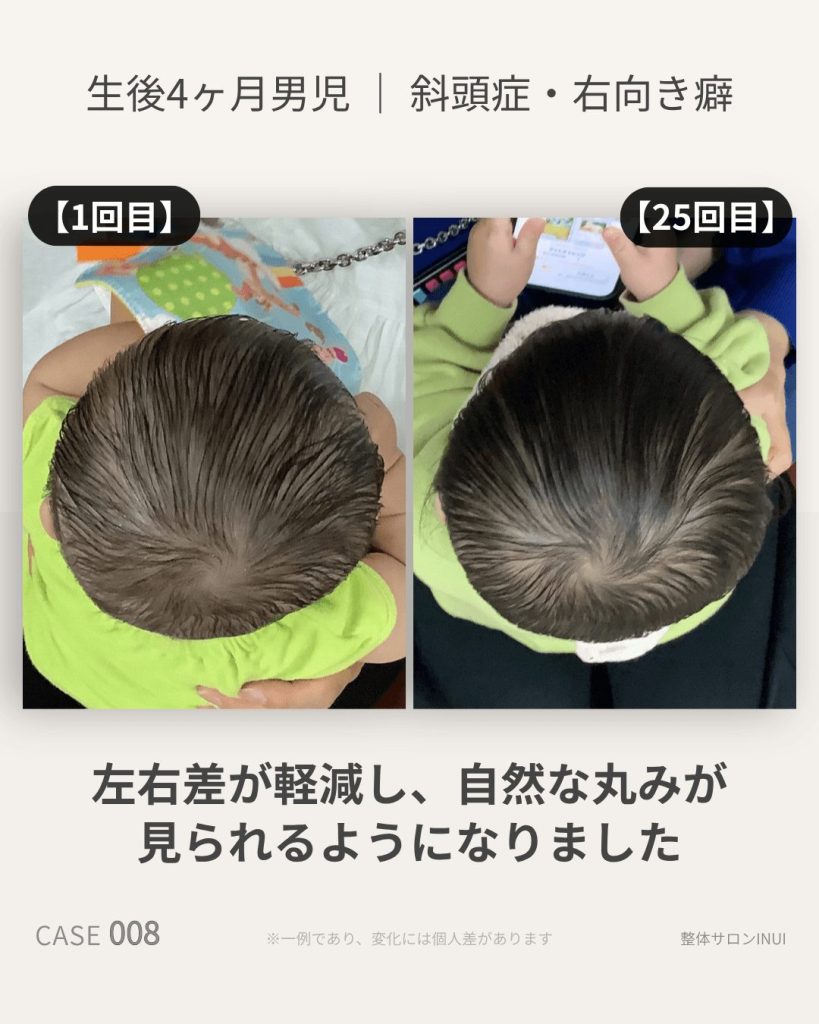 生後4ヶ月男児の斜頭症ビフォーアフター比較