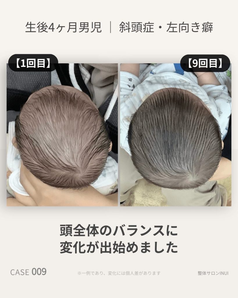 生後4ヶ月男児の斜頭症ビフォーアフター比較