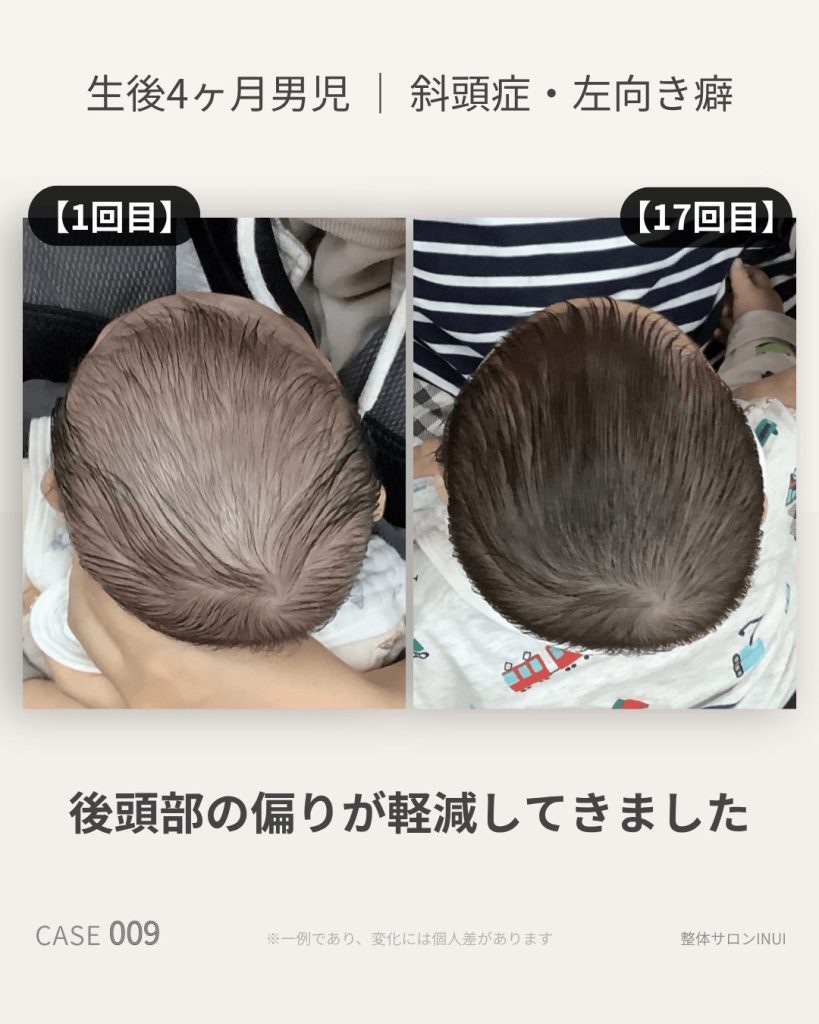 生後4ヶ月男児の斜頭症ビフォーアフター比較