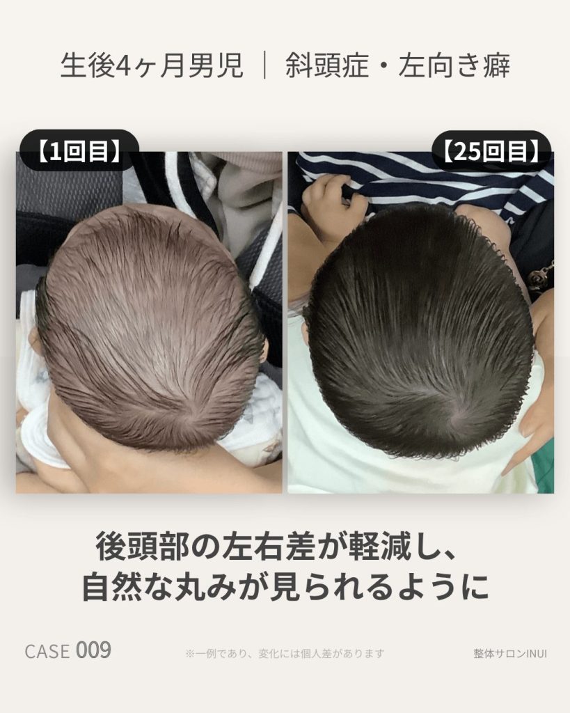 生後4ヶ月男児の斜頭症ビフォーアフター比較