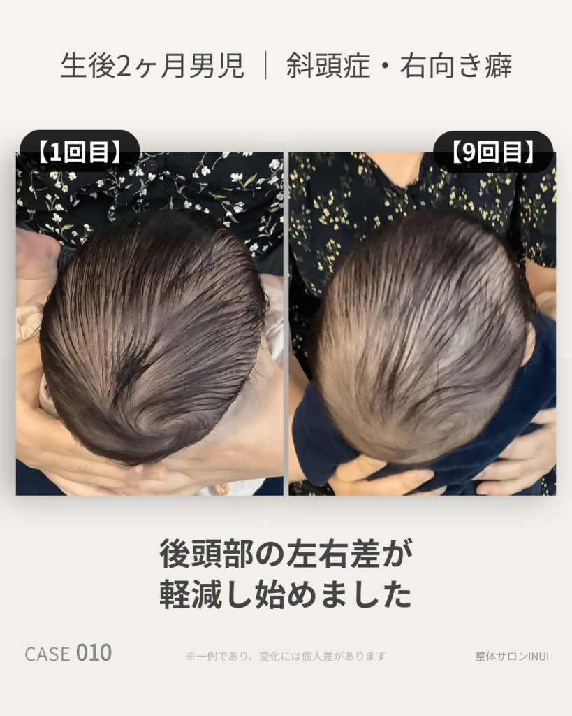 生後2ヶ月男児の斜頭症ビフォーアフター比較