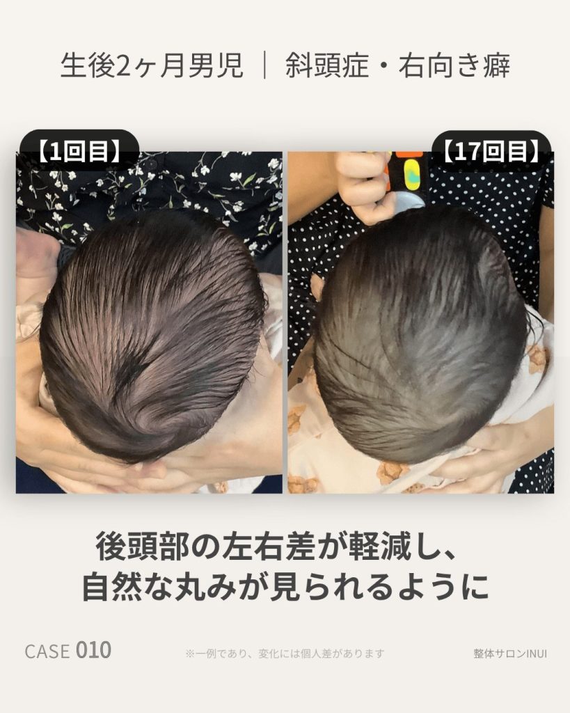 生後2ヶ月男児の斜頭症ビフォーアフター比較