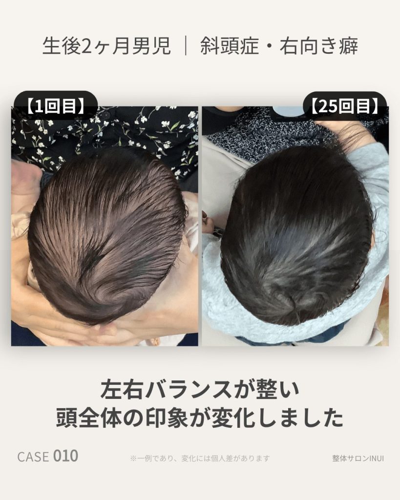 生後2ヶ月男児の斜頭症ビフォーアフター比較
