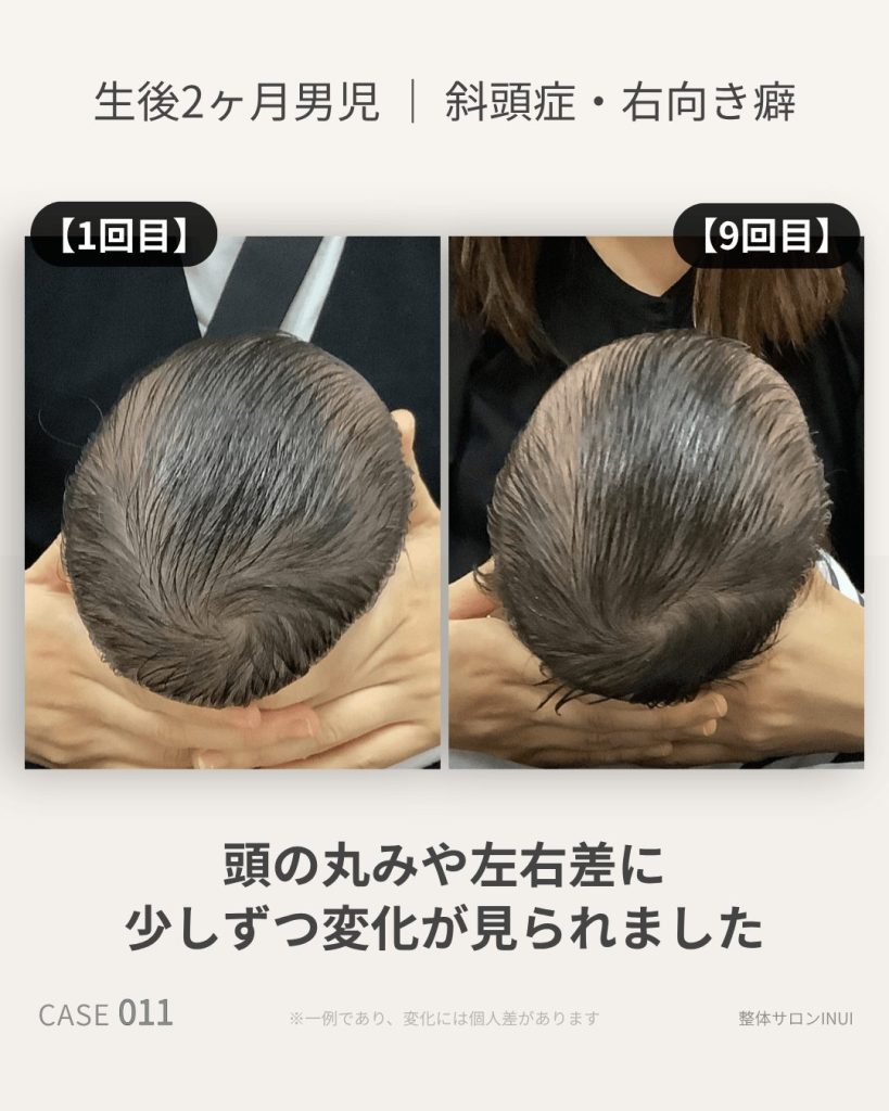 生後2ヶ月男児の斜頭症ビフォーアフター比較