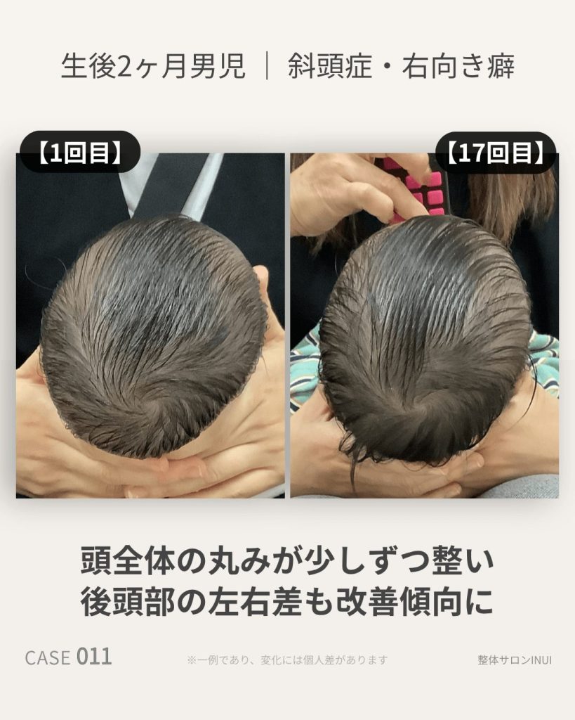 生後2ヶ月男児の斜頭症ビフォーアフター比較