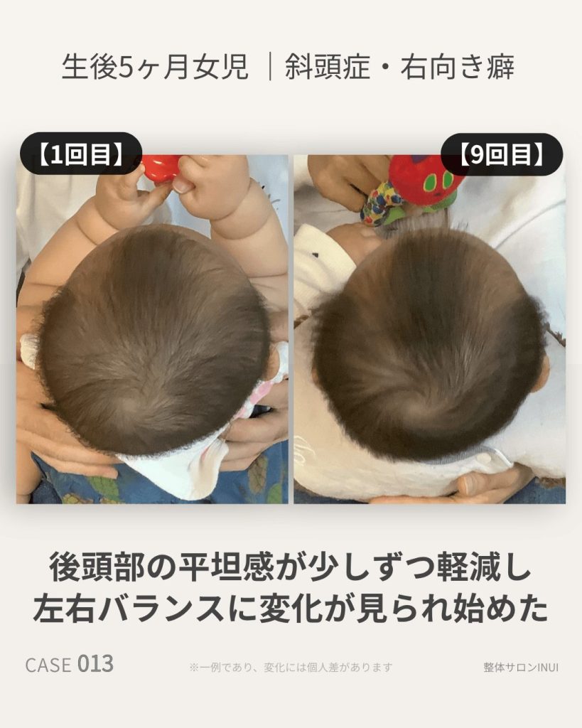 生後5ヶ月女児の斜頭症ビフォーアフター比較