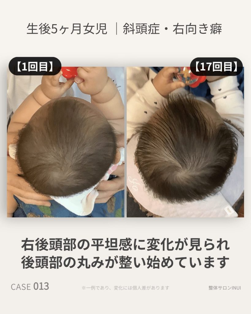 生後5ヶ月女児の斜頭症ビフォーアフター比較