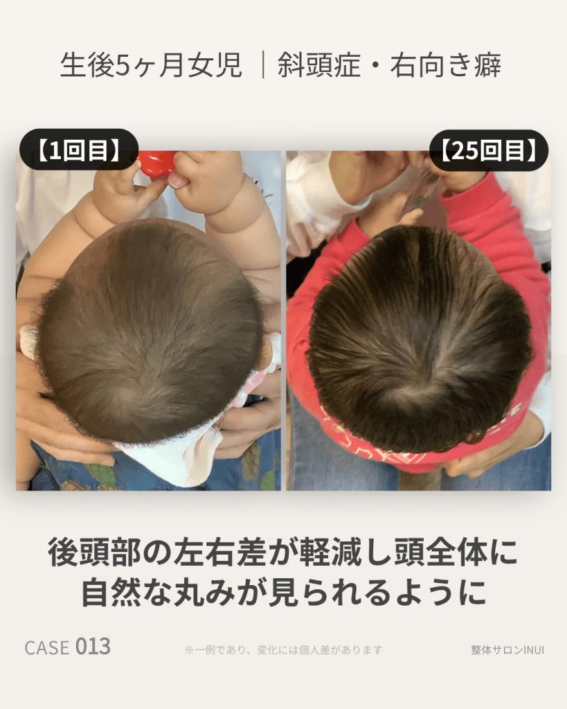 生後5ヶ月女児の斜頭症ビフォーアフター比較