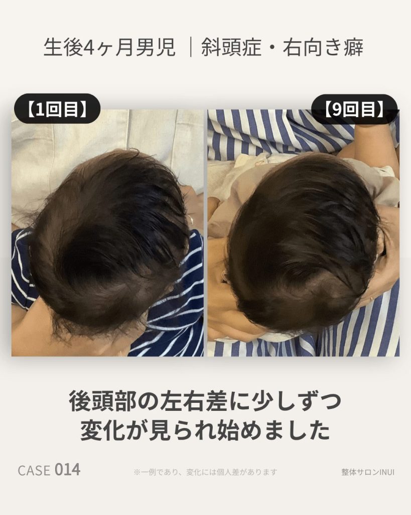生後4ヶ月男児の斜頭症ビフォーアフター比較