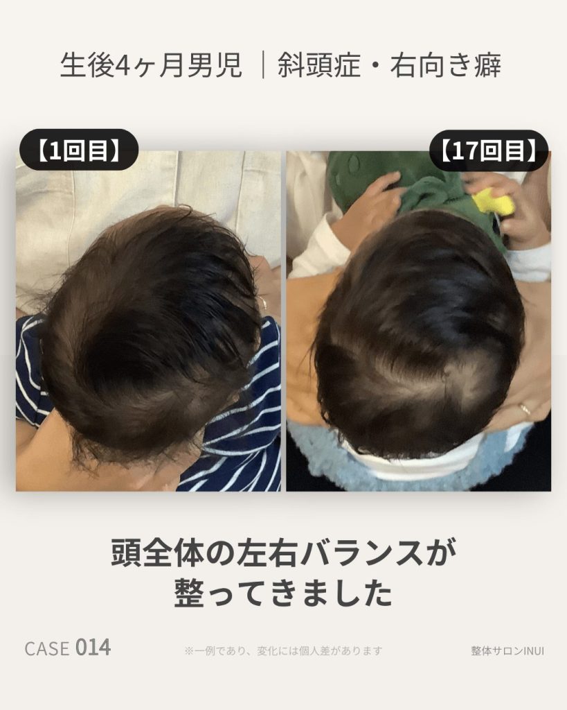 生後4ヶ月男児の斜頭症ビフォーアフター比較