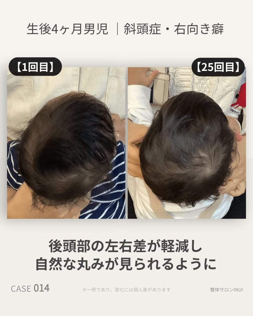 生後4ヶ月男児の斜頭症ビフォーアフター比較