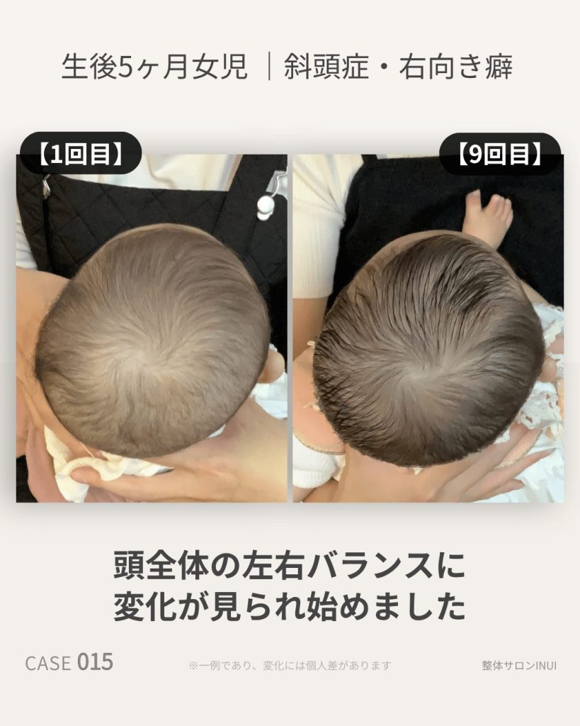 生後5ヶ月女児の斜頭症ビフォーアフター比較