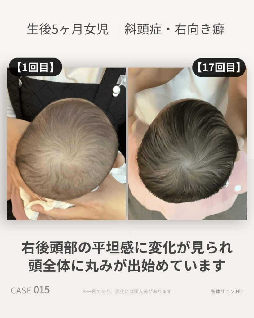 生後5ヶ月女児の斜頭症ビフォーアフター比較