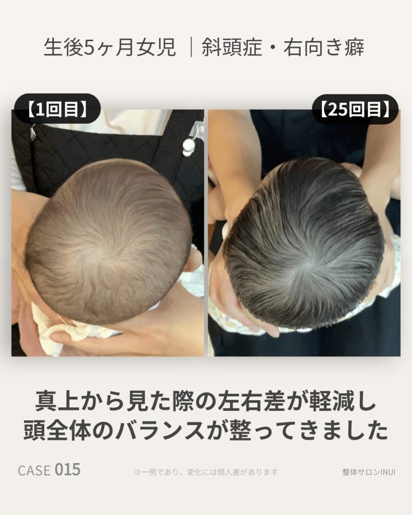 生後5ヶ月女児の斜頭症ビフォーアフター比較