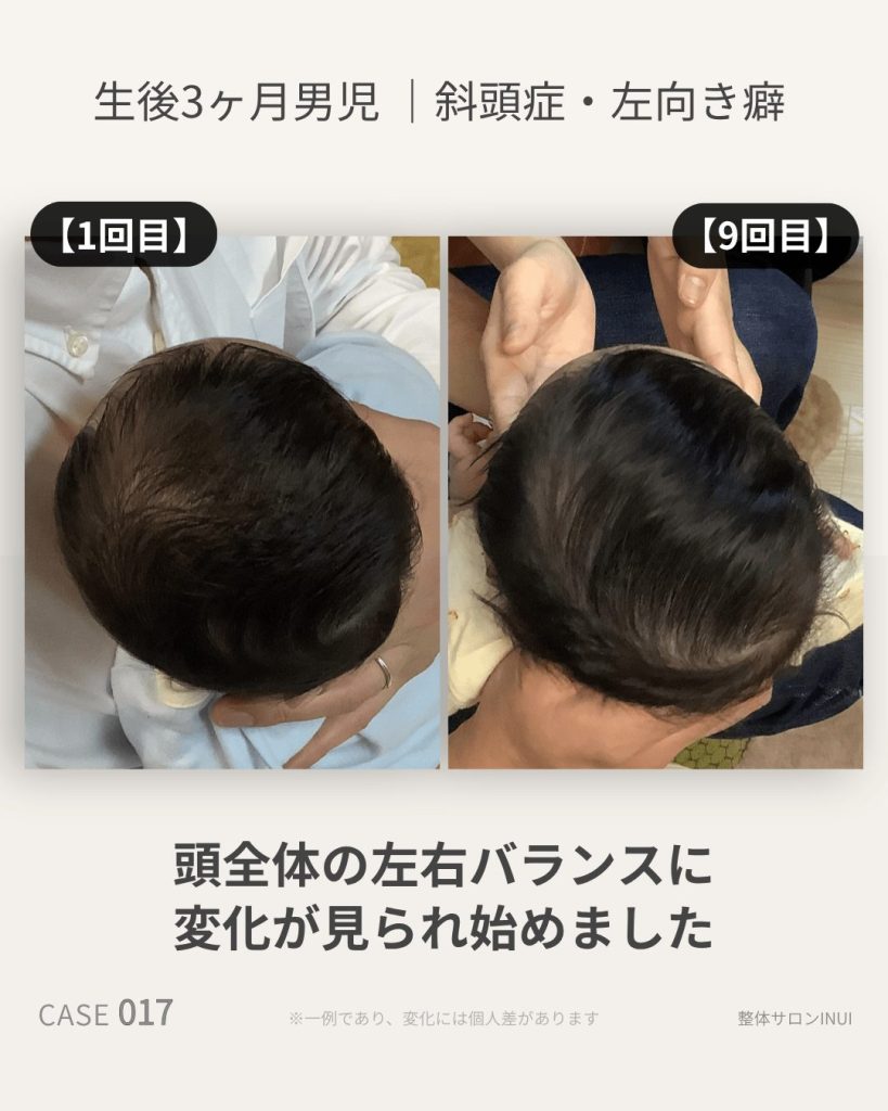 生後3ヶ月男児の斜頭症ビフォーアフター比較