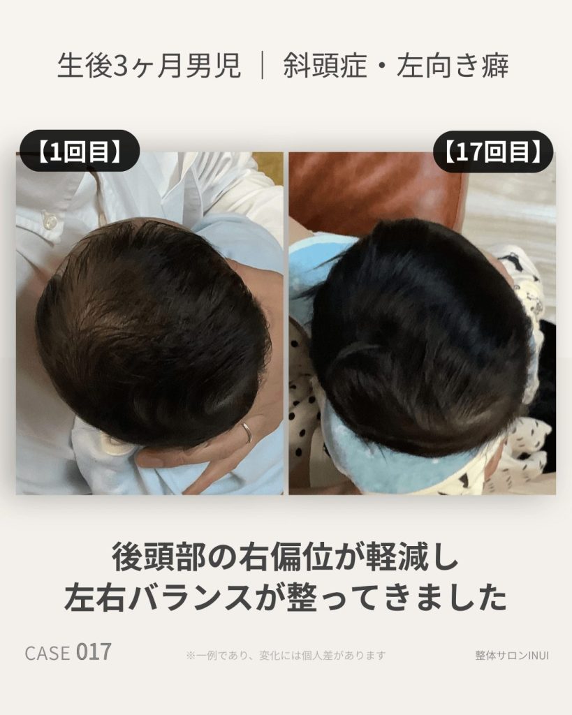 生後3ヶ月男児の斜頭症ビフォーアフター比較