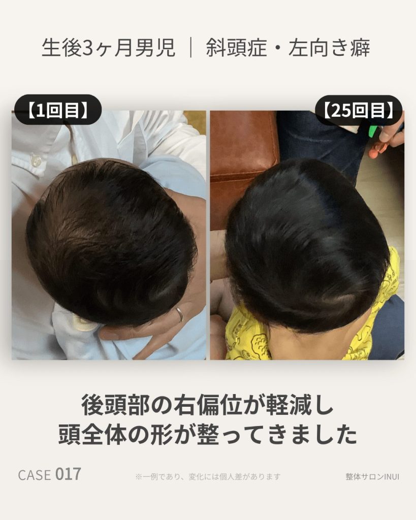 生後3ヶ月男児の斜頭症ビフォーアフター比較