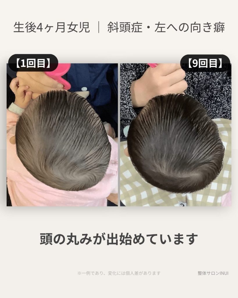 生後4ヶ月女児の斜頭症ビフォーアフター比較
