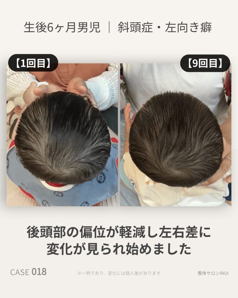 生後6ヶ月男児の斜頭症ビフォーアフター比較