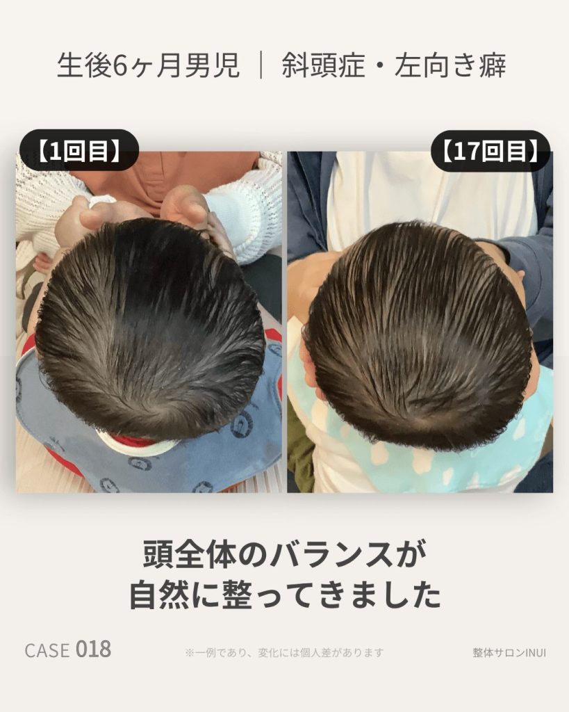 生後6ヶ月男児の斜頭症ビフォーアフター比較