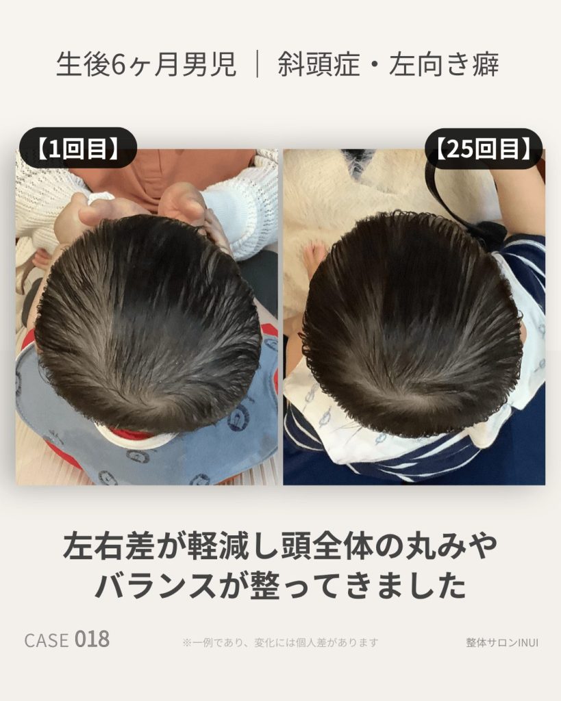 生後6ヶ月男児の斜頭症ビフォーアフター比較