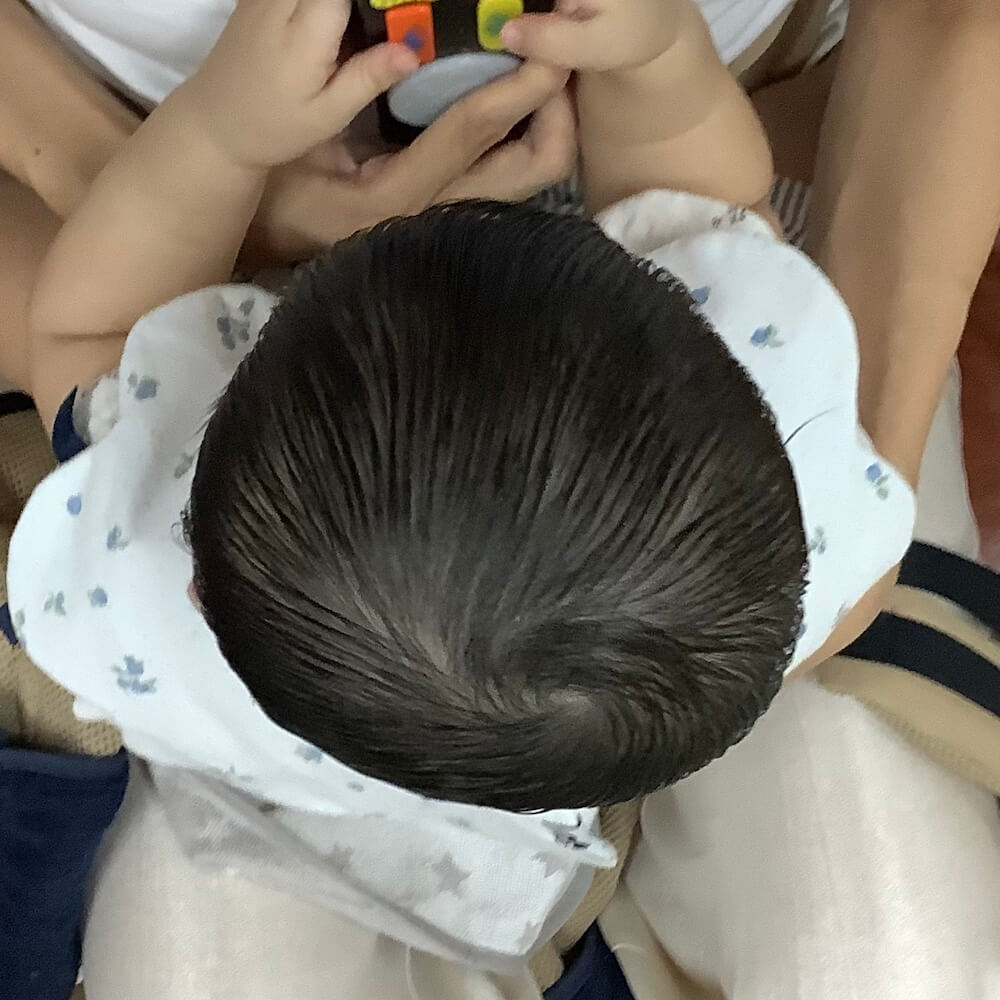 生後8ヶ月女児の斜頭症による後頭部左右差