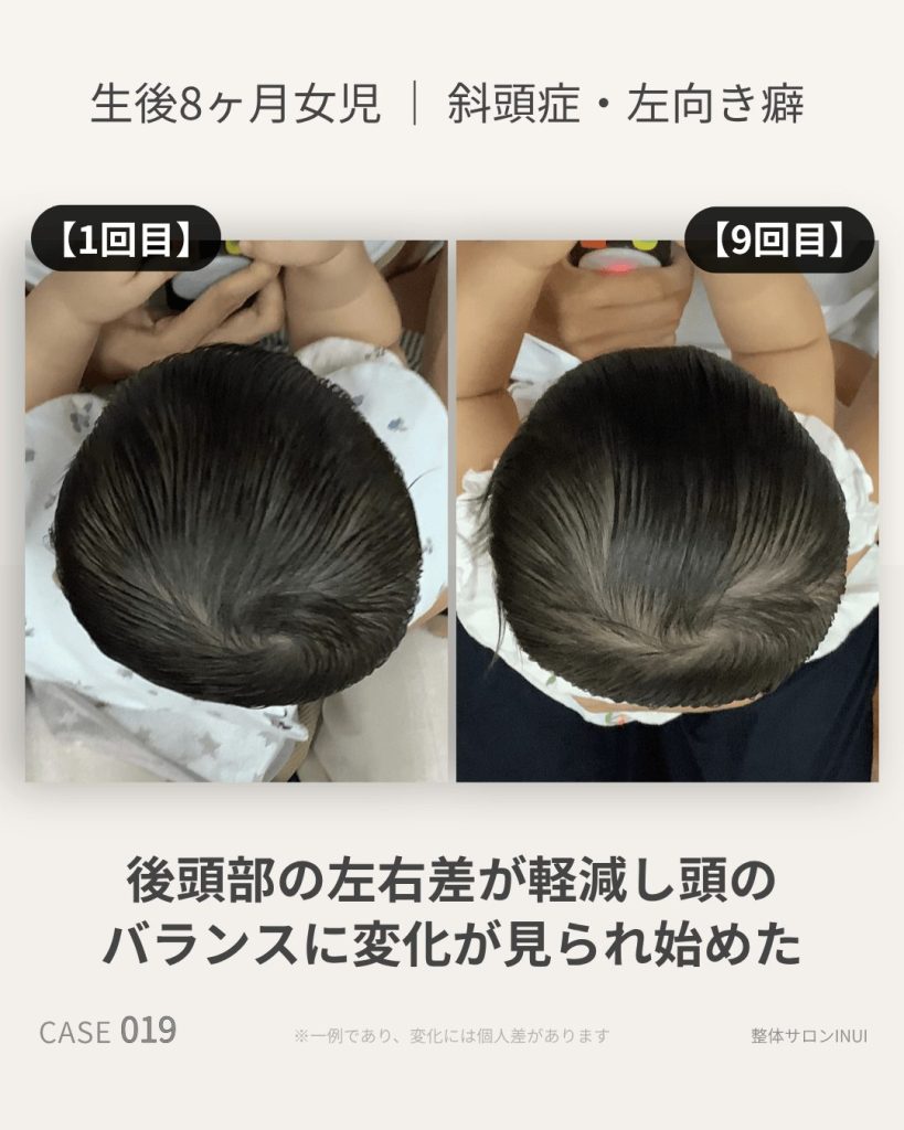 生後8ヶ月女児の斜頭症ビフォーアフター比較