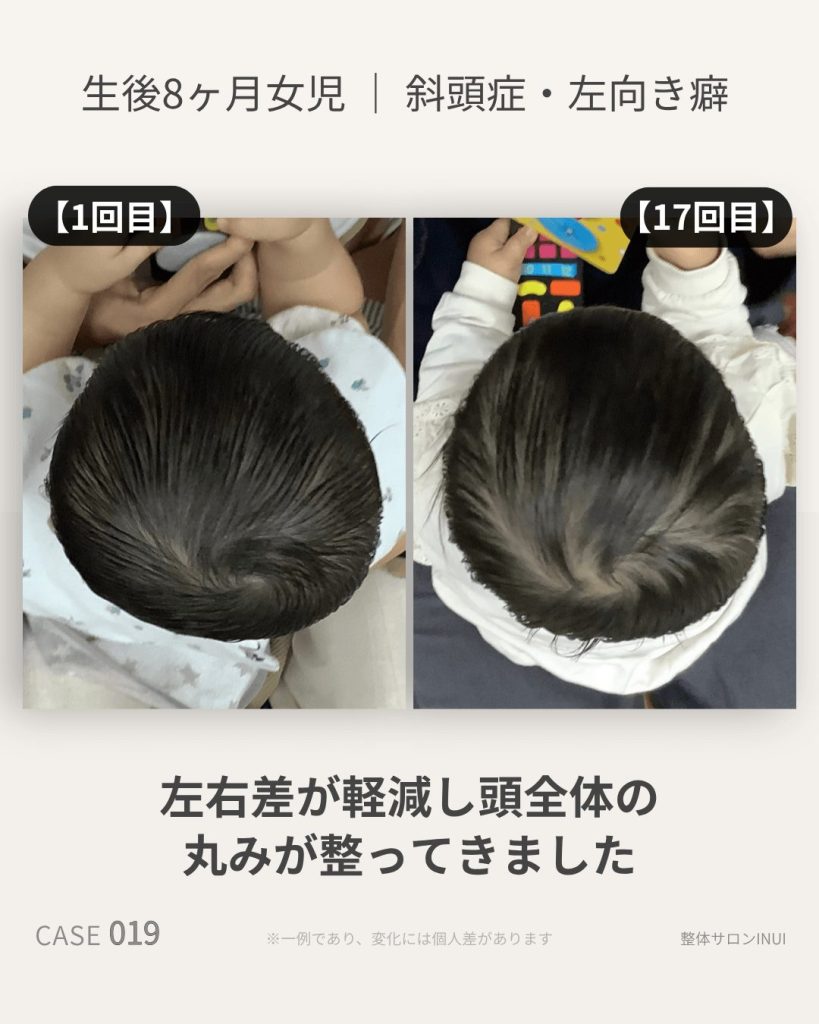生後8ヶ月女児の斜頭症ビフォーアフター比較