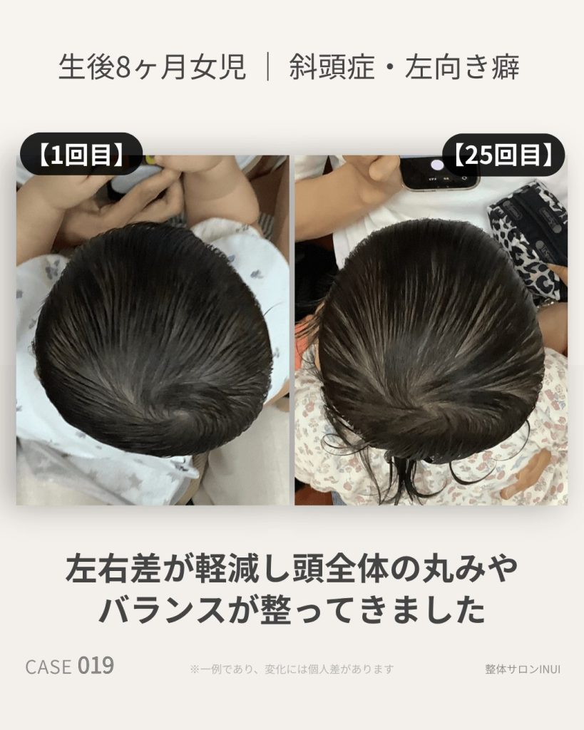 生後8ヶ月女児の斜頭症ビフォーアフター比較