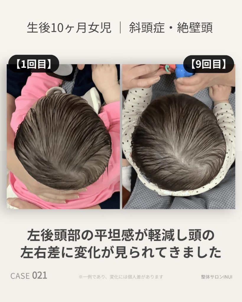 生後10ヶ月女児の斜頭症ビフォーアフター比較