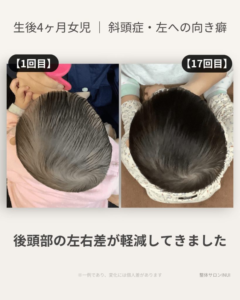 生後4ヶ月女児の斜頭症ビフォーアフター比較