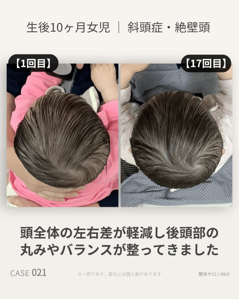 生後10ヶ月女児の斜頭症ビフォーアフター比較