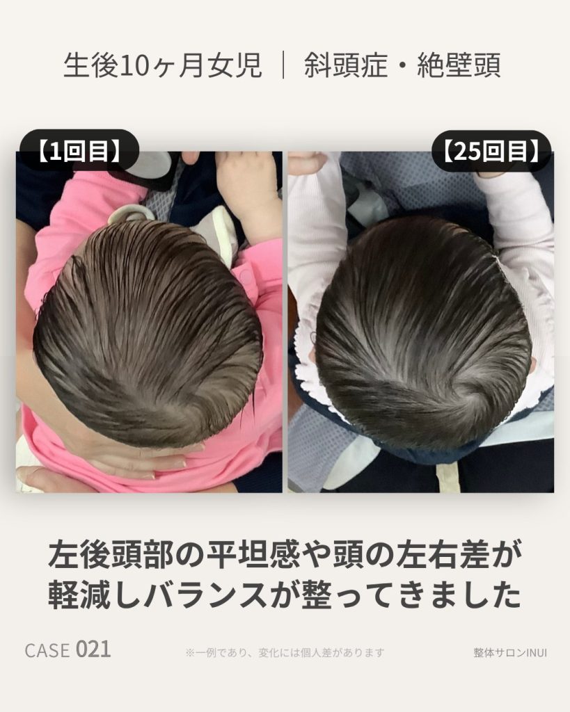 生後10ヶ月女児の斜頭症ビフォーアフター比較