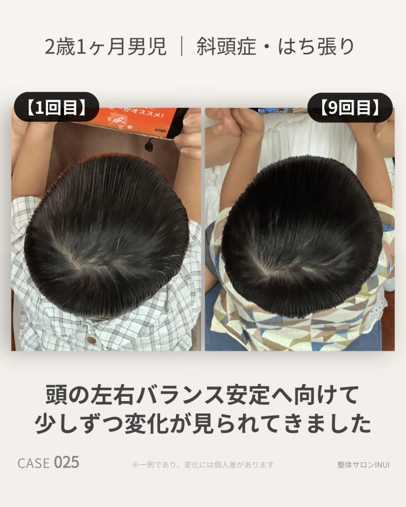 2歳1ヶ月男児の斜頭症ビフォーアフター比較