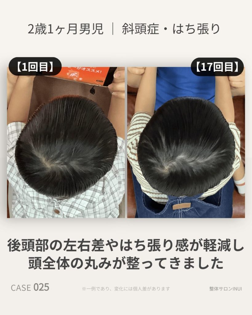 2歳1ヶ月男児の斜頭症ビフォーアフター比較