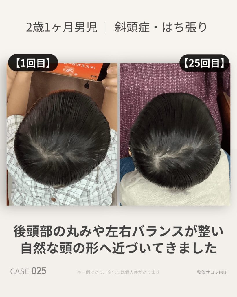 2歳1ヶ月男児の斜頭症ビフォーアフター比較
