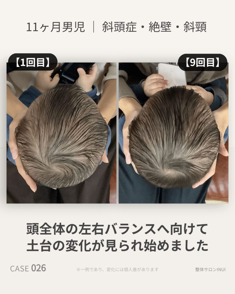 生後11ヶ月男児の斜頭症ビフォーアフター比較