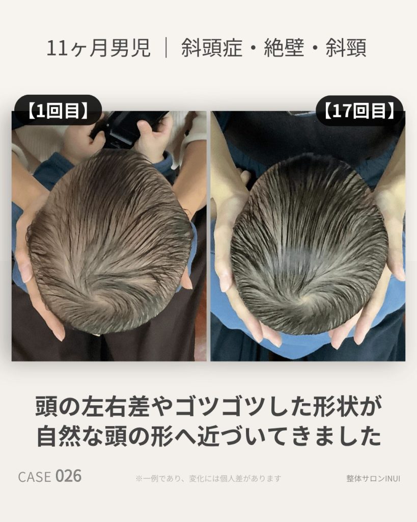 生後11ヶ月男児の斜頭症ビフォーアフター比較