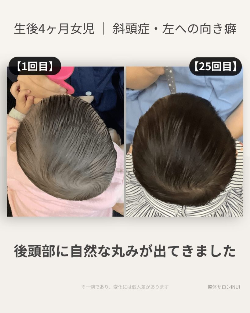 生後4ヶ月女児の斜頭症ビフォーアフター比較