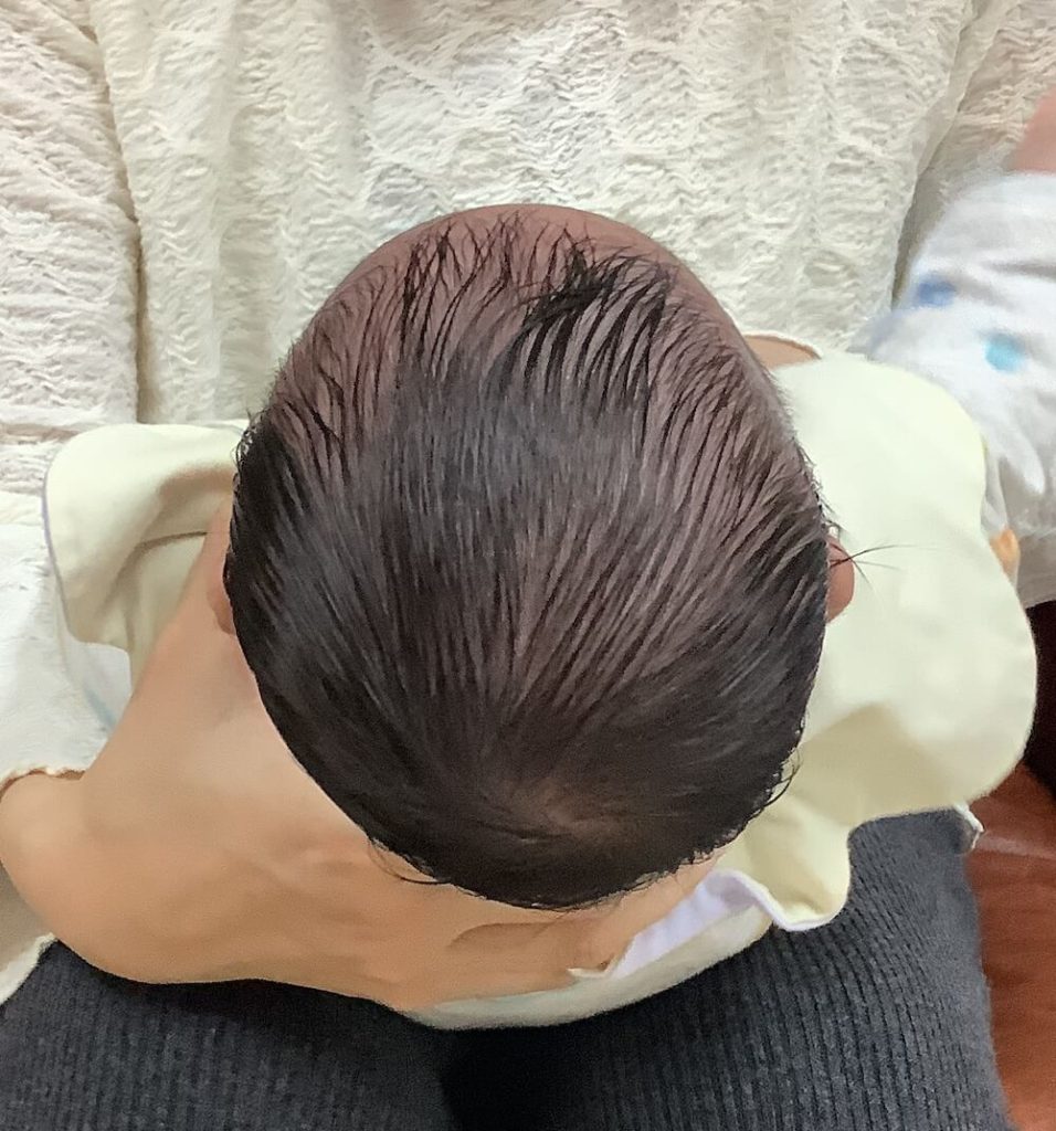 生後3ヶ月男児の斜頭症による後頭部左右差