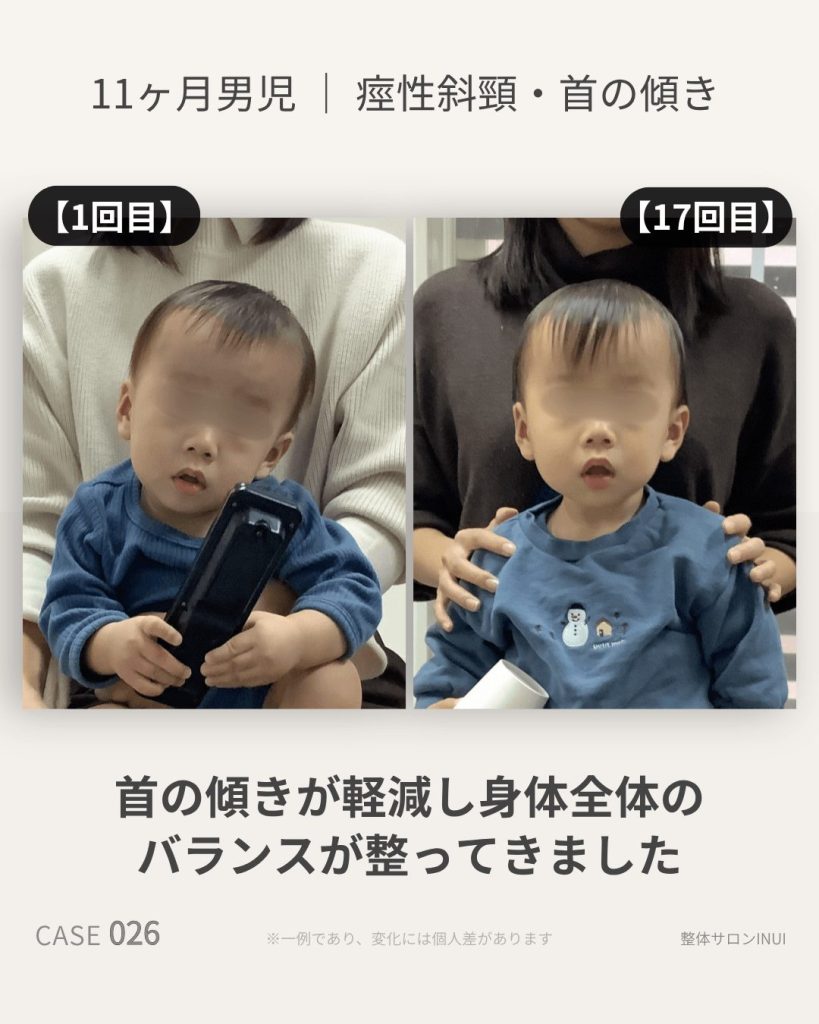 生後11ヶ月男児の痙性斜頸による首の傾きの変化比較
