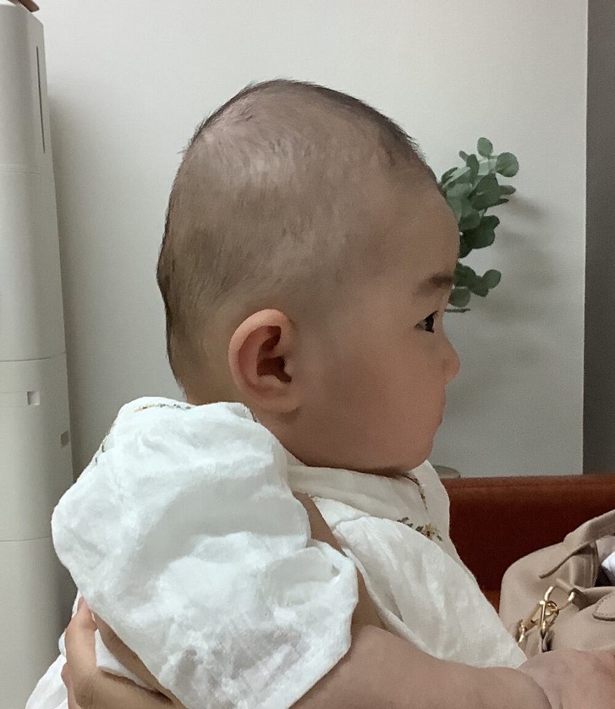 生後4ヶ月女児の絶壁頭による後頭部の平坦感