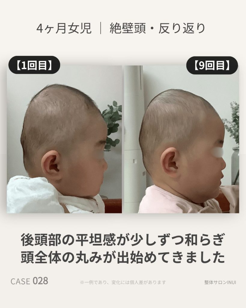 生後4ヶ月女児の絶壁頭ビフォーアフター比較