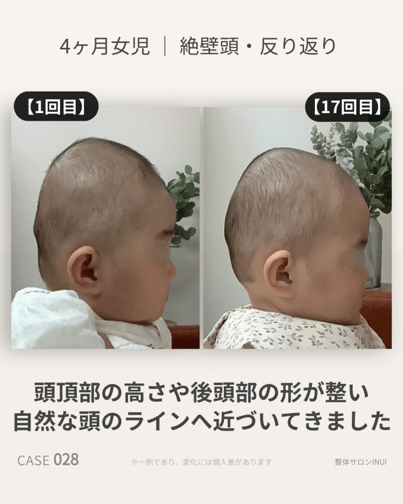 生後4ヶ月女児の絶壁頭ビフォーアフター比較