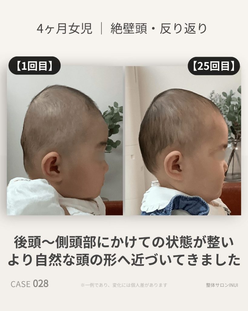 生後4ヶ月女児の絶壁頭ビフォーアフター比較