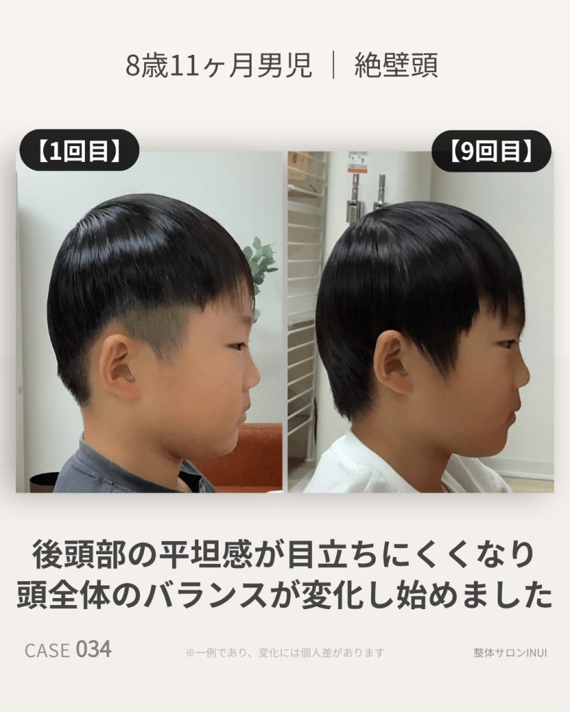 8歳11ヶ月男児の絶壁頭ビフォーアフター比較