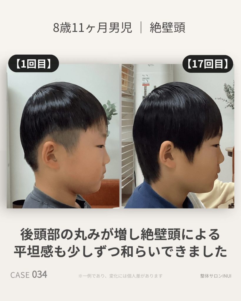 8歳11ヶ月男児の絶壁頭ビフォーアフター比較