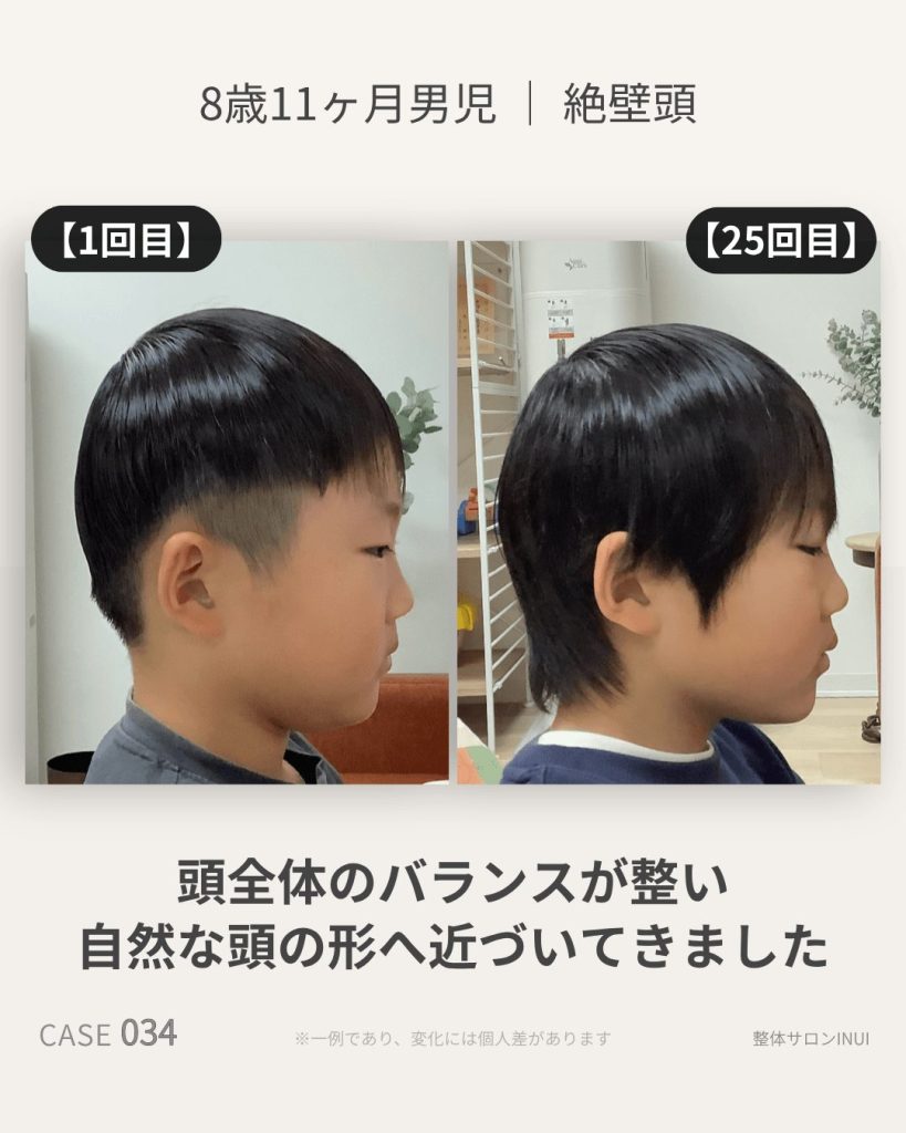 8歳11ヶ月男児の絶壁頭ビフォーアフター比較