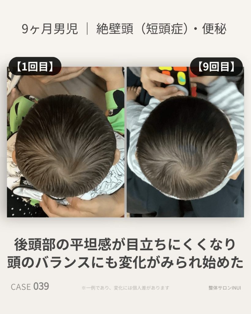 生後9ヶ月男児の絶壁頭ビフォーアフター比較