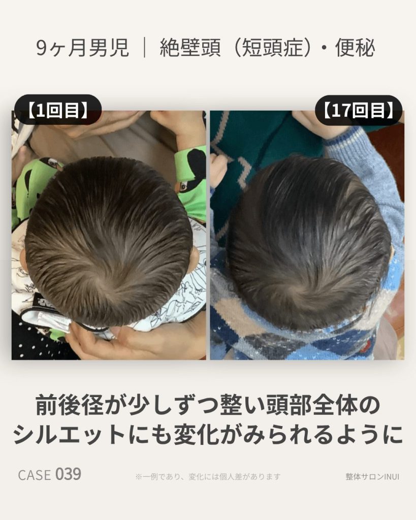 生後9ヶ月男児の絶壁頭ビフォーアフター比較